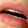 Lippenbalsem Koortslip - Afbeelding 2