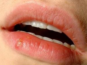 Lippenbalsem Koortslip - Afbeelding 2